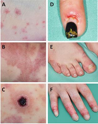 Vasculitis in Juvenile-Onset Systemic Lupus Erythematosus